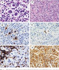 Lymphomas with intermediate features}, author={s. Figure 4 From Two Cases Of Mediastinal Gray Zone Lymphoma Semantic Scholar