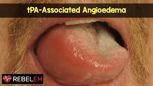 Image result for Angioedema