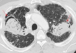 This intensely antigenic and ubiquitous soil fungus is commonly found in the sputum of healthy individuals. Ct Findings Of Fungal Pneumonia With Emphasis On Aspergillosis Springerlink