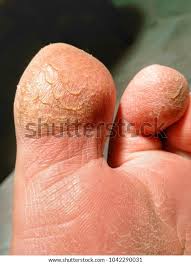 Image result for Anhidrosis