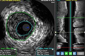 Ein ultraschall des herzens oder eine kernspintomografie können dem arzt informationen bereitstellen, ob die herzfunktion beeinträchtigt ist. Kardiologie Im Elisabeth Krankenhaus Rheydt Stadtische Kliniken Monchengladbach Herzkatheter