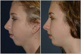 Chin Augmentation Weak Chin Augmentation