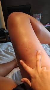 My allergic reaction to a mosquito bite. This is 9hrs after bite, an oral  antihistamine, and topical hydrocortisone, and menthol spray. Still hot,  swollen and hard and feels like an orange peel :