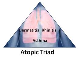 Image result for Allergic Triad