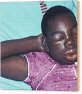 Bee Sting Reaction by Science Photo Library