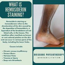 Image result for Pigment stains on the shin