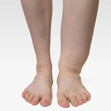 Image result for Localized Edema