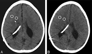 Fig 2 Low Dose Nonenhanced Head Ct Protocol For Follow Up Evaluation Of Children With Ventriculoperitoneal Shunt Reduction Of Radiation And Effect On Image Quality American Journal Of Neuroradiology