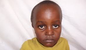 Success! Willy from Tanzania raised $940 to fund orthopedic surgery.