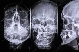 Image result for Sinus X Ray