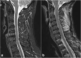 If you have it, please remember to check that your private health insurance covers mri of the cervical spine in case your doctor refers you for . Role Of Magnetic Resonance Imaging In Acute Spinal Trauma A Pictorial Review Bmc Musculoskeletal Disorders Full Text