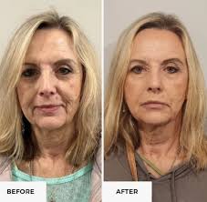 Swipe for the magic of NeoGen Plasma! ✨ NeoGen is a game-changer for  treating fine lines, wrinkles, sun damage, and even acne scars. The best  part? It's non-invasive with long-lasting results that