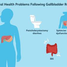 However, it is not without complications. What To Do About Ibs After Gallbladder Removal