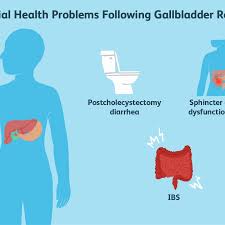 gallbladder removal what to eat for