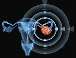 Missed ovarian cancer on ct scan. What Tests Evaluate An Ovarian Mass For Cancer