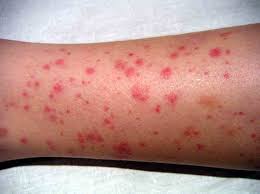 Check spelling or type a new query. 9 Leukemia Rashes Bruises And Other Skin Manifestations Anti Leukemia