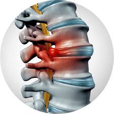 Image result for Spinal Infection