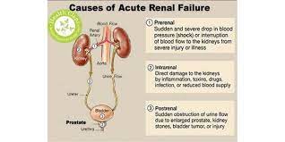 Post renal causes of kidney failure (post=after + renal= kidney) are due to factors that affect outflow of the urine what is the prognosis and life expectancy for kidney failure? Acute Kidney Injury Classification Diagnosis And Management Health And Medicine