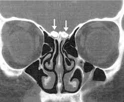 Calcification Of The Olfactory Bulbs In Three Patients With Hyposmia American Journal Of Neuroradiology