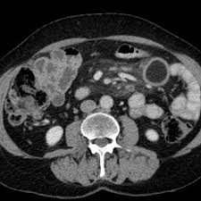 Cavitating Mesenteric Lymph Node Syndrome Ct Findings Eurorad