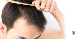This is factor #1, of course. 9 Signs To Identify If It S Likely For You To Go Bald Ahs India