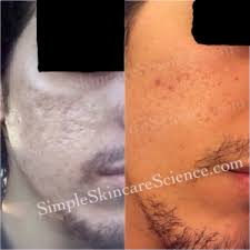 Adapalene prevents breakouts, blackheads, whiteheads, blemishes and clogged pores as well while restoring skin tone and texture by clearing acne. How To Get Rid Of Acne Scars Explained 7 Studies Pie Vs Pih