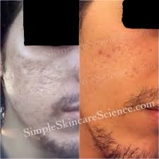 See full list on wikihow.com How To Get Rid Of Acne Scars Explained 7 Studies Pie Vs Pih