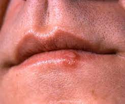 However, we can find hsv ii occurring above the neck & hsv i occurring below the waist because what matters is what area gets exposed to the virus. Can Oral Herpes Be Spread To Genitals Planned Parenthood Advocates Of Arizona