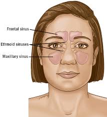 Most sinus cancers are squamous cell carcinomas that originate in the lining of the sinuses or nasal cavity. Nose Sinus Cancer Anatomy