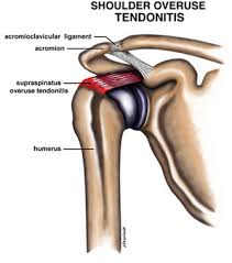 Diagram of normal bursae surrounding the shoulder joint: Shoulder Impingement Tendonitis Pinnacle Orthopaedics