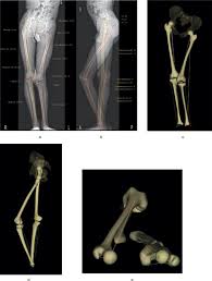 Image result for Functional Leg Length Discrepancy