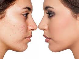 Fish Nuts Fennel Foods That Act As Natural Skin Cleansers And Keep Acne Away Keep Acne At Bay The Economic Times