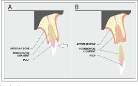 Image result for Tooth Avulsion