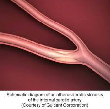 Find information on symptoms of carotid artery disease and how the decrease of blood flow to the brain can lead there are two common carotid arteries, located on each side of the neck like any other blood vessel in the body, carotid arteries are at risk for narrowing in individuals who smoke. Carotid Artery Disease Michigan Medicine