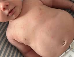 Image result for sweat rash on back baby