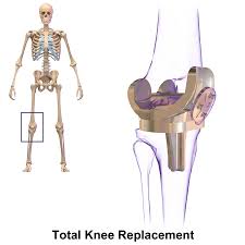 Amyn rajani, a known knee specialist in mumbai. Knee Replacement Wikipedia