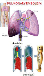 L'embolia polmonare rappresenta la terza causa di patologia cardiovascolare dopo l'infarto miocardico e l'ictus statisticamente i soggetti maggiormente colpiti da embolia polmonare sono le donne. La Malattia Tromboembolica