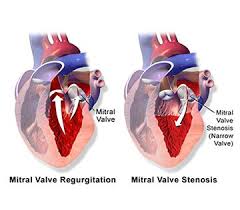 About Heart Valve Replacement Cost Procedure Doctors Heart Valves Mitral Valve Stenosis