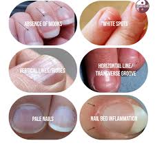 6 Signs Your Fingernails Are Telling You Something About Your Health Fingernail Health Nail Health Health Remedies