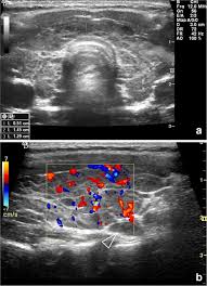 It is a form of idiopathic lymphocytic orbital inflammation, and although its pathogenesis is not completely understood, autoimmune activation of orbital fibroblasts, which in tao express the tsh receptor, is thought to play a central role. Pediatric Thyroid Ultrasound A Radiologist S Checklist Springerlink
