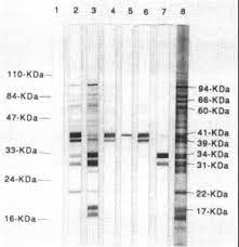 Lyme Disease Tests Learn About The Lyme Tests Available Lymedisease Org