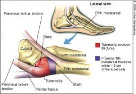 The joint damage manifests as decreased joint space, worn cartilage. Kids Outer Foot Pain My Footdr