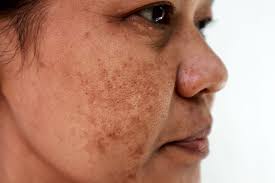 Image result for Melasma