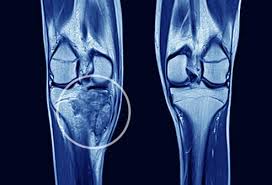 As the cancer develops, though, the pain may become more persistent. Visual Guide To Bone Cancer