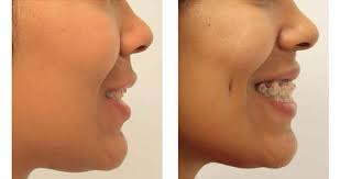 15 a rarer form is the single dimple, which occurs on one side of the face only. Face Surgery For Dimple Creation By Dr Anurag Bhargava