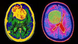 Brain Tumor Statistics | Brain Tumor Center | Everydayhealth.com