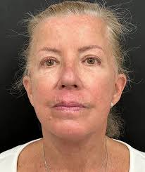 Best Facelift In NYC & Long Island