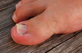 Image result for Koilonychia feet