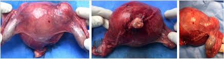 Persistent Mullerian Duct Syndrome Rare Presentation In An Elderly Man Bmj Case Reports
