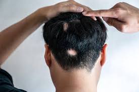 Image result for Alopecia